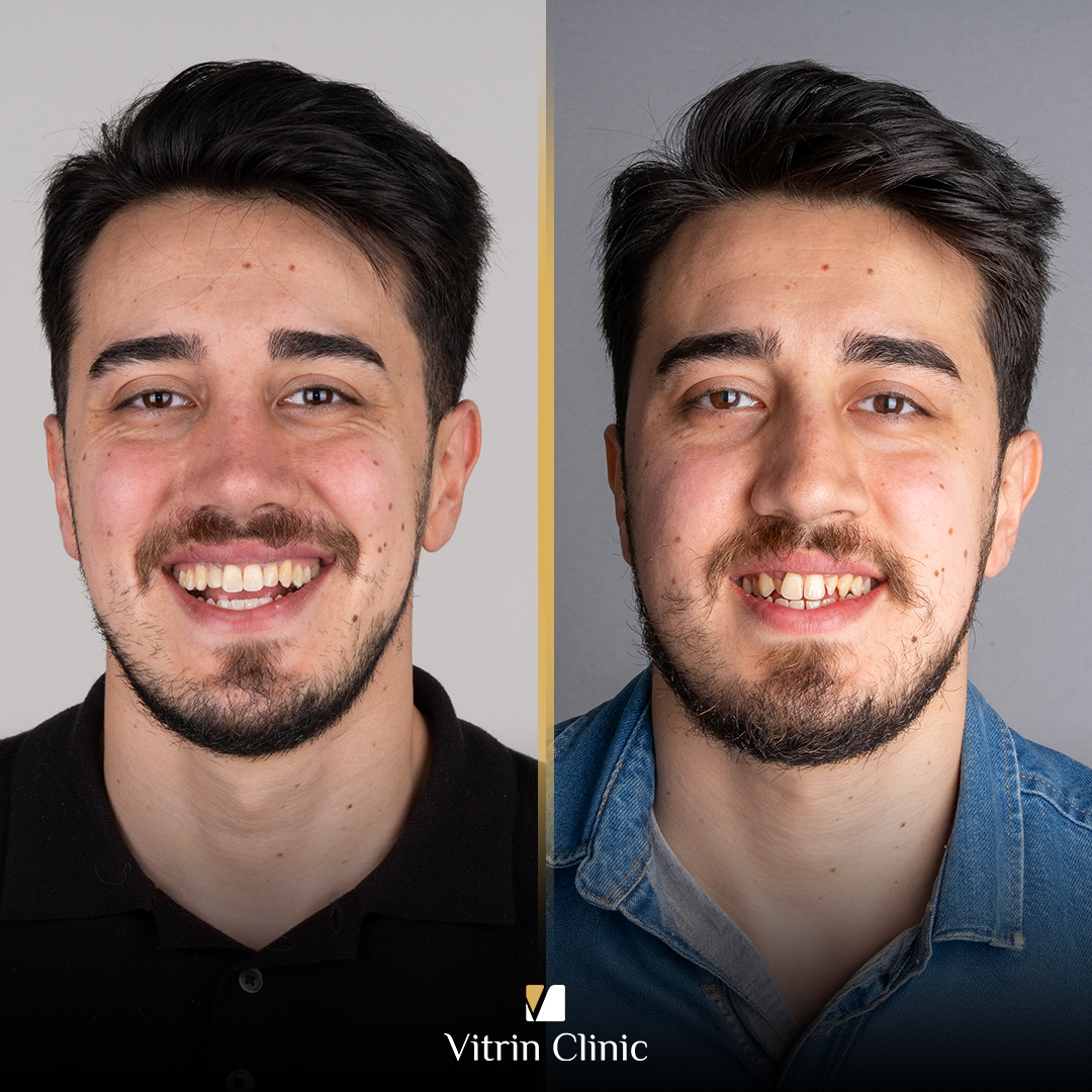 La vitamine C pour les dents : est-elle bonne ou mauvaise pour vos dents et vos gencives ?